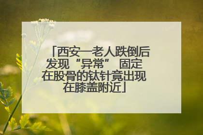 西安一老人跌倒后发现“异常” 固定在股骨的钛针竟出现在膝盖附近